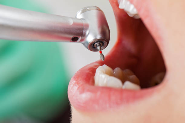 Best Emergency Tooth Extraction in Round Lake, IL